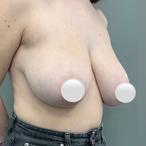 Breast Reduction