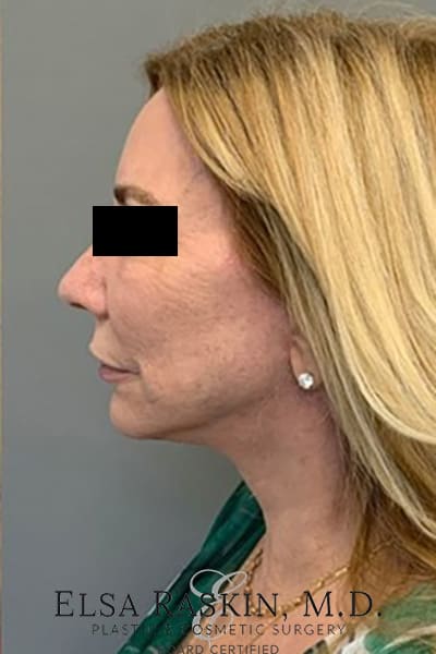 Facelift