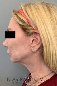 Facelift