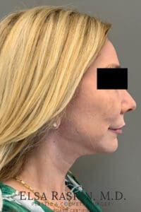 Facelift