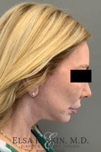 Facelift