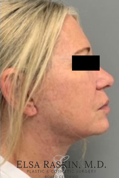 Facelift