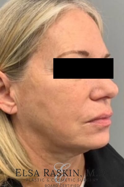 Facelift