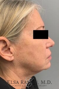 Facelift