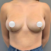 Breast Reduction