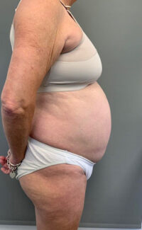 Tummy Tuck (Abdominoplasty)