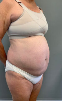 Tummy Tuck (Abdominoplasty)