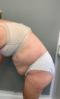 Tummy Tuck (Abdominoplasty)