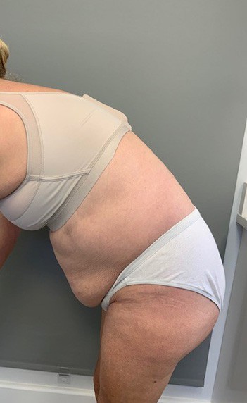 Tummy Tuck (Abdominoplasty)