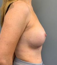 Breast Augmentation