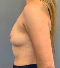 Breast Augmentation