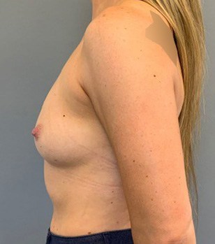 Breast Augmentation