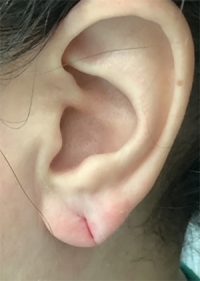 Earlobe Repair/Reduction