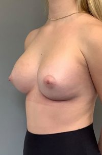 Breast Augmentation