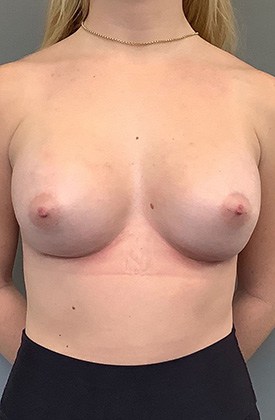 Breast Augmentation