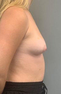 Breast Augmentation
