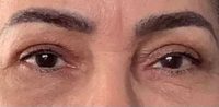 Blepharoplasty