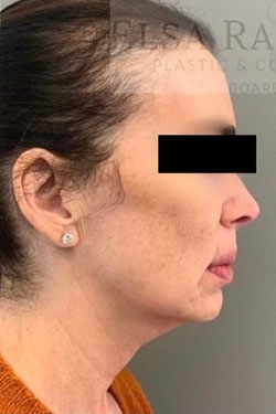 Facelift