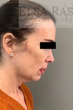 Facelift