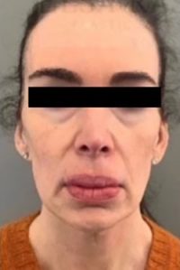Facelift