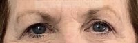 Blepharoplasty