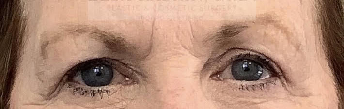Blepharoplasty