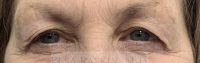 Blepharoplasty