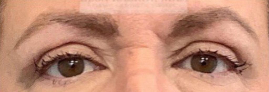 Face Surgery