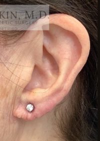 Face Surgery