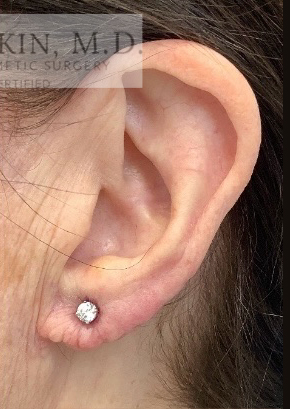 Face Surgery