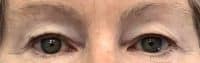 Face Surgery