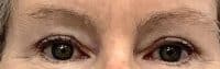 Face Surgery