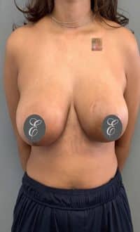 Breast Surgery