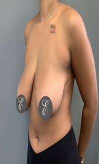 Breast Surgery