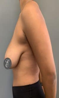 Breast Surgery