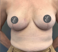 Breast Reduction