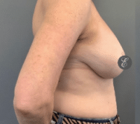 Breast Reduction