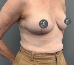 Breast Reduction