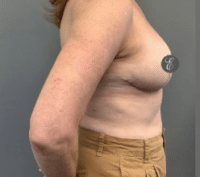 Breast Reduction