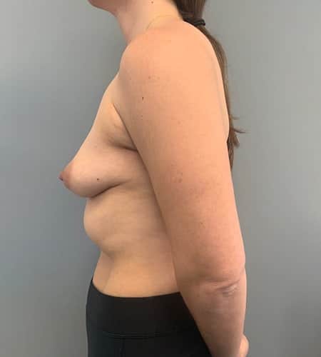 Before Image: Breast Augmentation - left-side