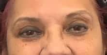 After Image: Ptosis Repair - front