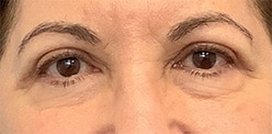 After Image: Blepharoplasty - front