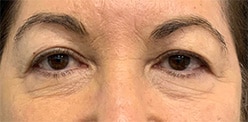 Before Image: Blepharoplasty - front