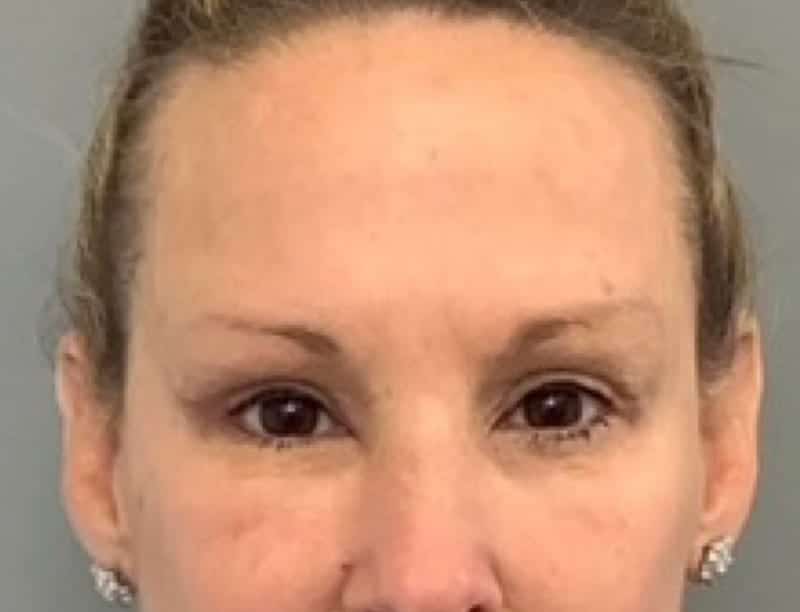 After Image: Blepharoplasty - front