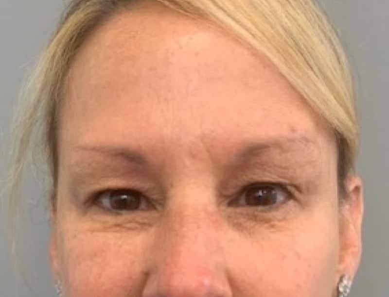Before Image: Blepharoplasty - front