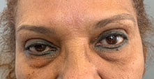 Before Image: Blepharoplasty - front