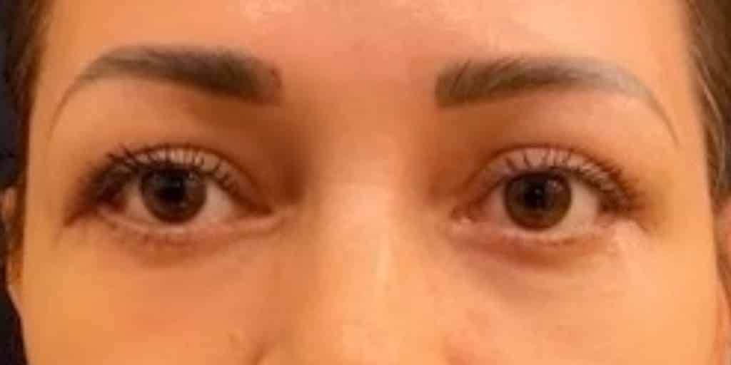 After Image: Blepharoplasty - front