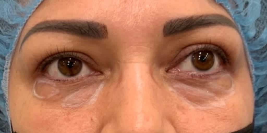 Before Image: Blepharoplasty - front