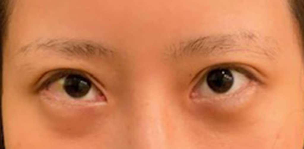 After Image: Blepharoplasty - front