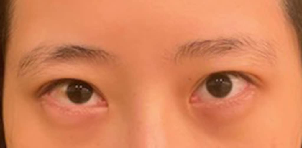 Before Image: Blepharoplasty - front